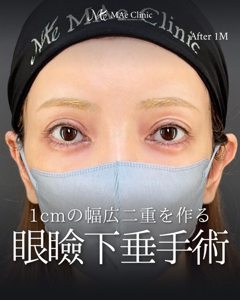 眼瞼下垂手術 前之園健太医師症例