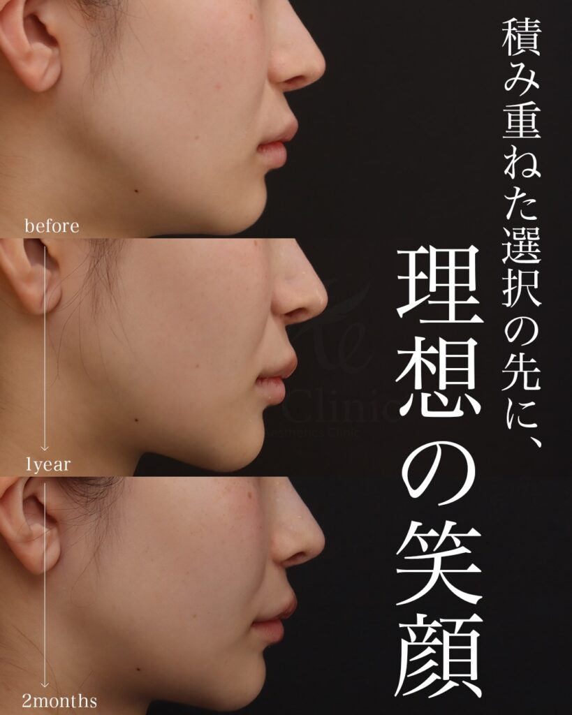 【1回目】 裏人中短縮 3D厚み調整 鼻翼縮小(内側) 猫貴族手術(肋軟骨) 【2回目】 人中短縮 貴族手術 前田翔医師症例