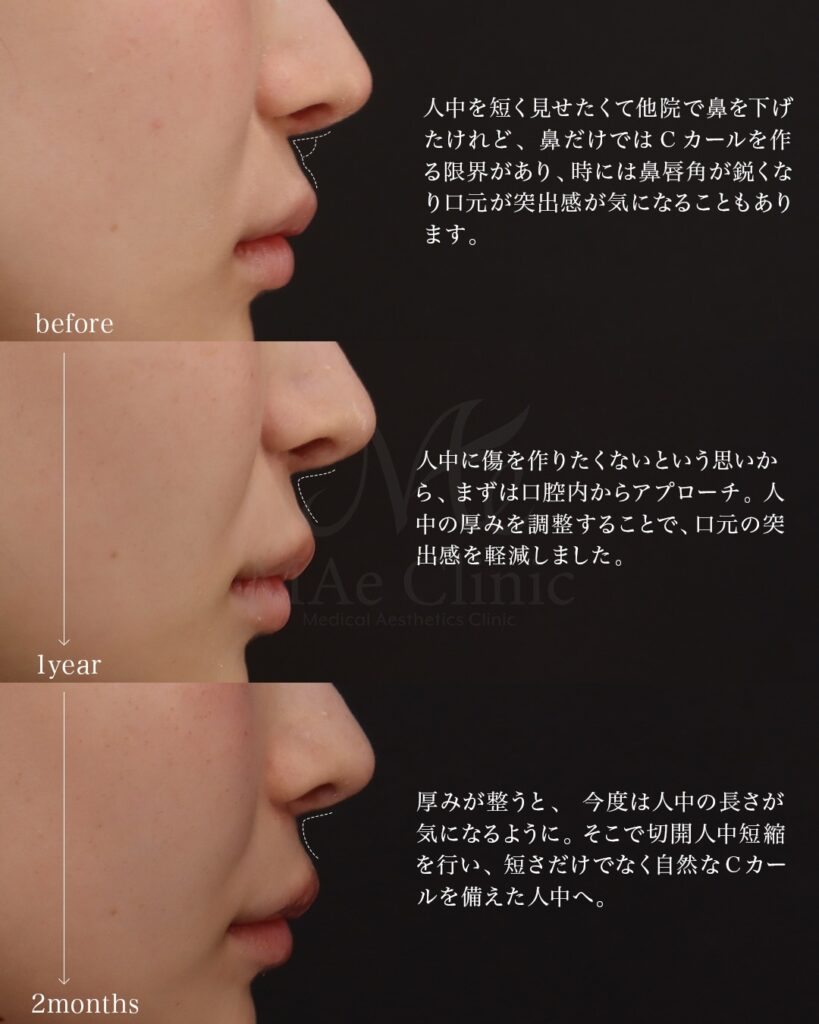 【1回目】 裏人中短縮 3D厚み調整 鼻翼縮小（内側） 猫貴族手術（肋軟骨） 【2回目】 人中短縮 貴族手術 前田翔医師症例