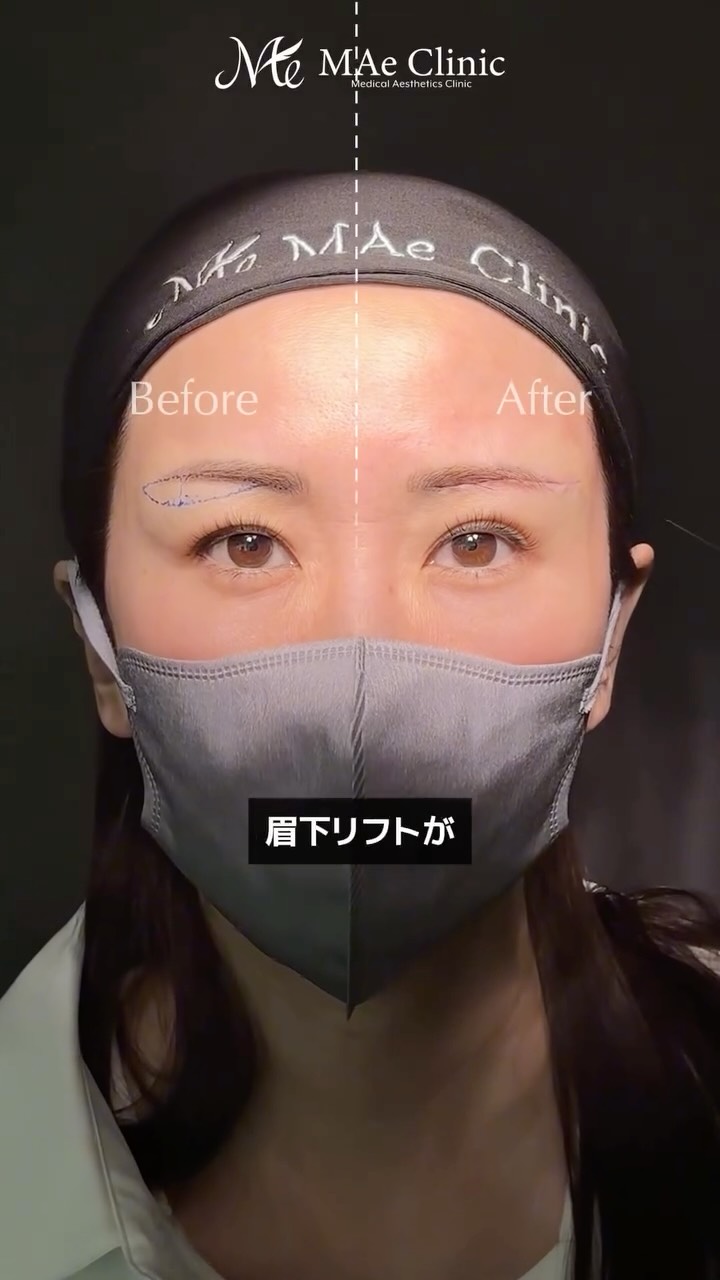 片目の眉下リフト直後比較から見るたるみ改善と二重幅露出の効果を検証