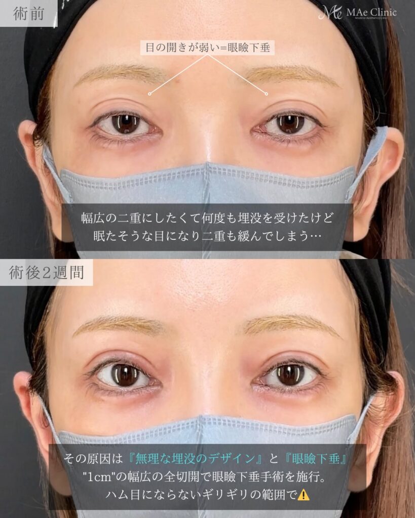眼瞼下垂手術
前之園健太医師症例