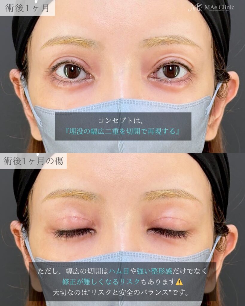 眼瞼下垂手術 前之園健太医師症例