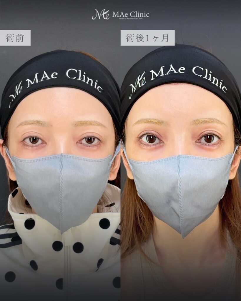 眼瞼下垂手術 前之園健太医師症例