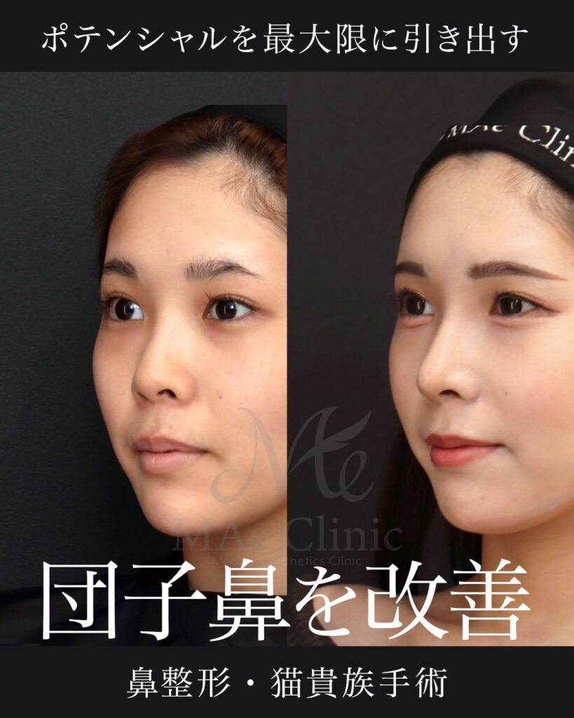 鼻中隔延長術（肋軟骨） 鼻尖形成術 鼻尖軟骨移植術 鼻背細片軟骨移植術（隆鼻術） 猫貴族手術 前田翔医師症例