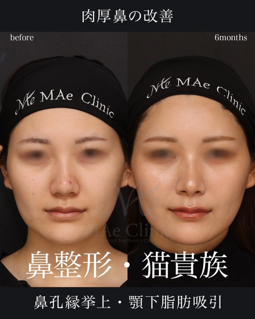 鼻中隔延長術（肋軟骨）
鼻尖形成術
鼻尖軟骨移植術
猫手術（肋軟骨による鼻唇角形成術）
鼻孔縁挙上術
顎下脂肪吸引術
症例