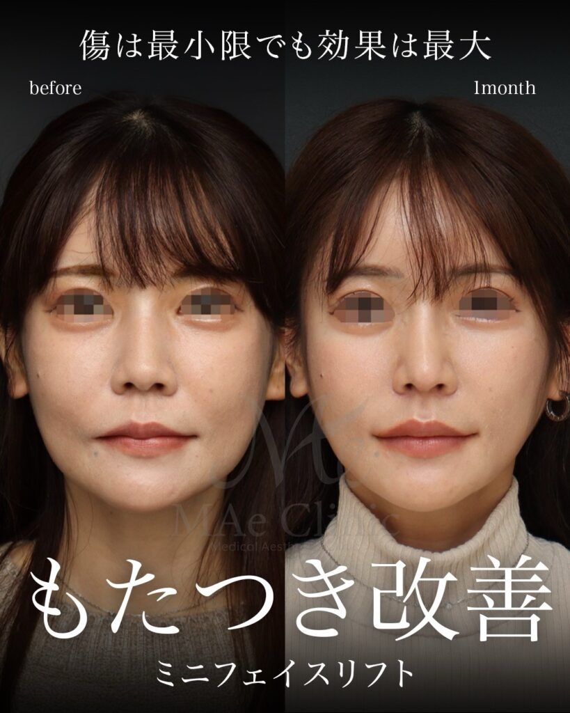 ミニフェイスリフト（切開フェイスリフト）
糸リフト（スレッドリフト）
※本症例ではお顔全体のバランスを包括的に整えるため、以下の施術も同時に施行しておりますが、本解説では「フェイスリフトによる輪郭改善」を中心に紐解きます。
（併用施術：鼻フル[鼻中隔延長術＋鼻尖形成術＋鼻尖軟骨移植術]、隆鼻術[肋軟骨]、アクアミド除去術、猫貴族手術、口角挙上術、裏人中短縮術）
前田翔医師症例