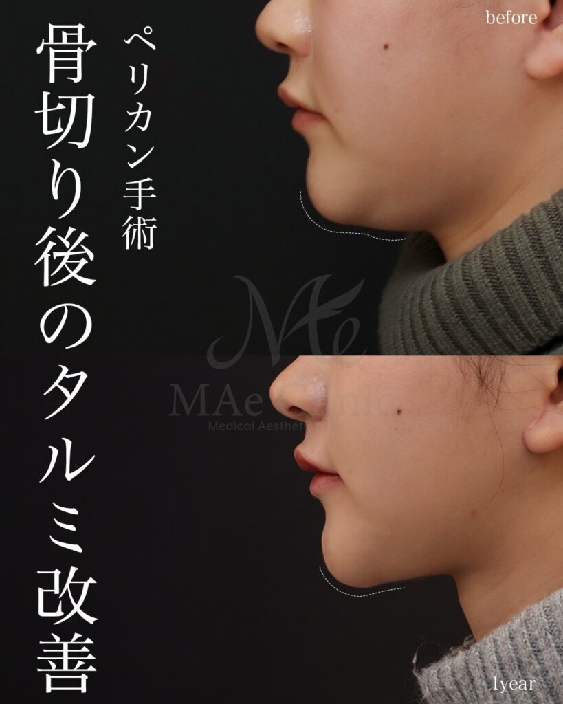 ペリカン手術 前田翔医師症例