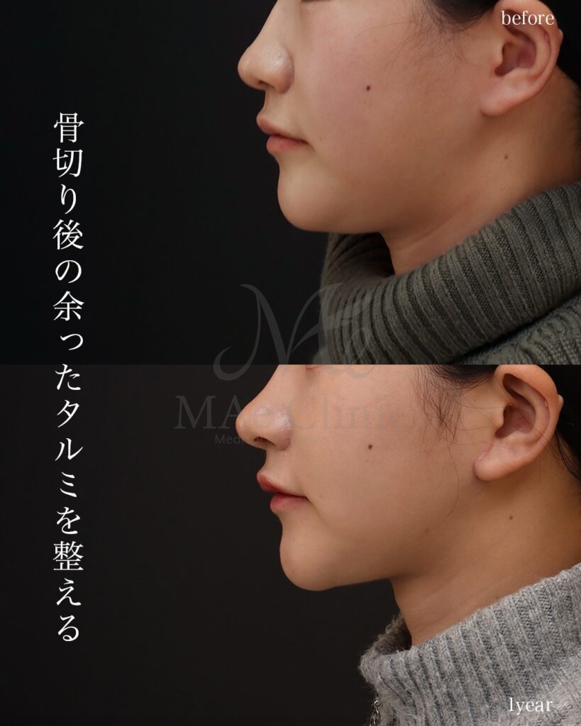 ペリカン手術 前田翔医師症例