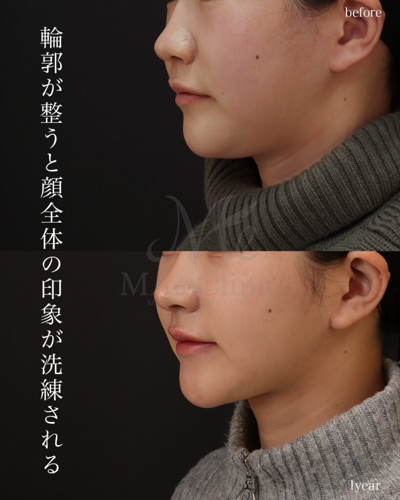 ペリカン手術 前田翔医師症例
