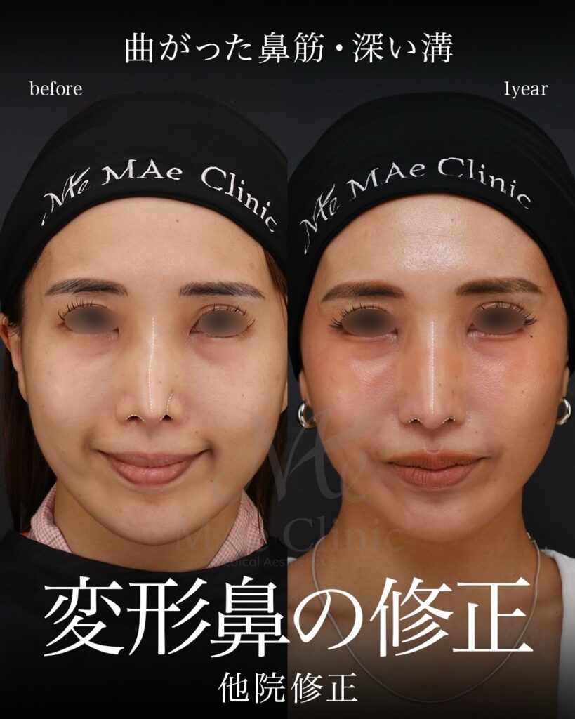1段階目：鼻中隔延長術（自家組織による再建）＋ 鼻尖形成術 ＋ 鼻尖軟骨移植術（いわゆる「鼻フル」による土台再建・アライメント修正） 2段階目：鼻孔縁下降術（皮膚・軟骨移植による鼻翼の切れ込み修正） 前田翔医師症例