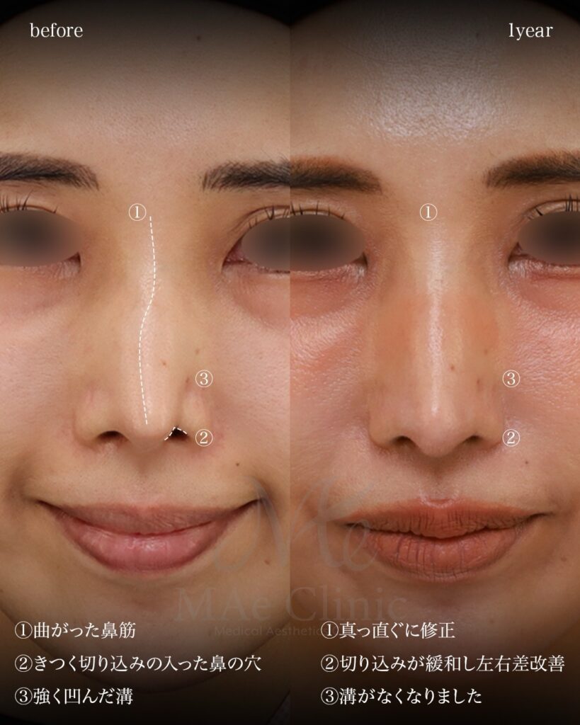 1段階目：鼻中隔延長術（自家組織による再建）＋ 鼻尖形成術 ＋ 鼻尖軟骨移植術（いわゆる「鼻フル」による土台再建・アライメント修正） 2段階目：鼻孔縁下降術（皮膚・軟骨移植による鼻翼の切れ込み修正） 前田翔医師症例