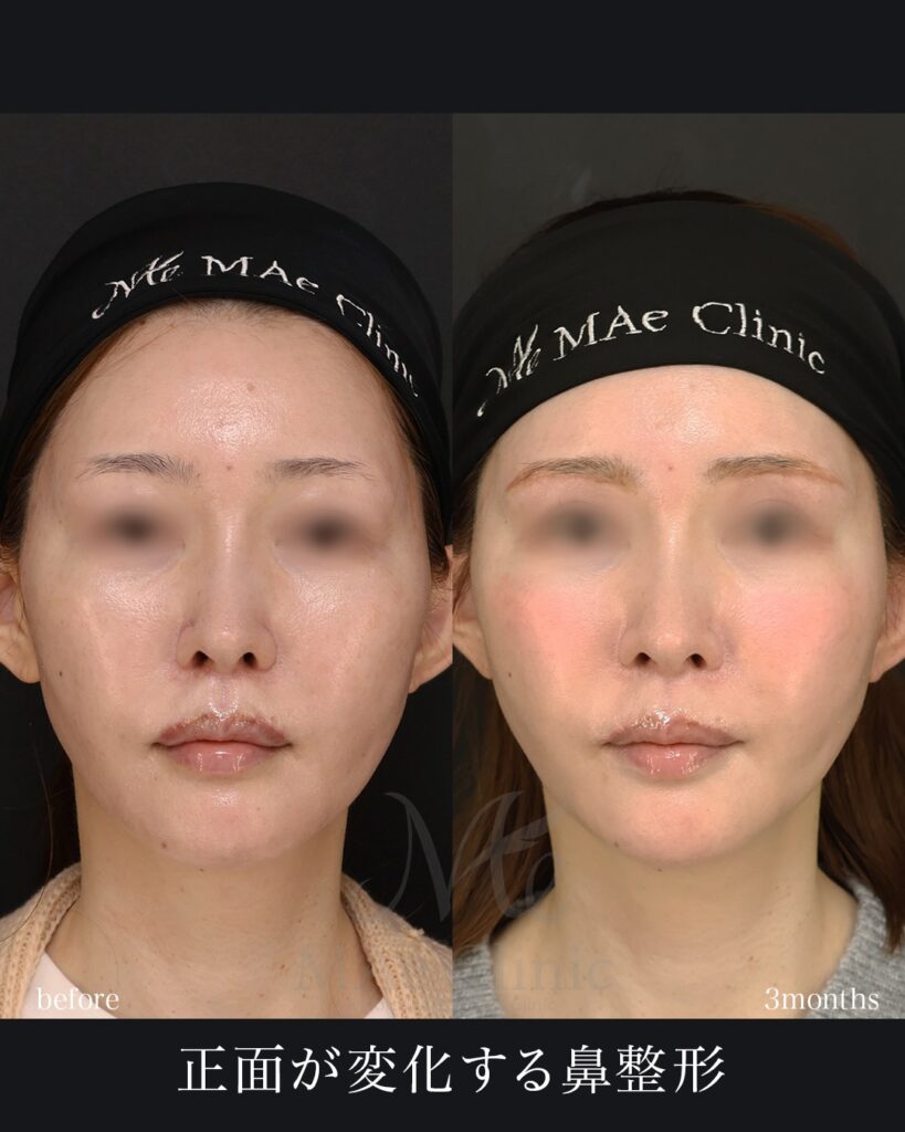 鼻翼挙上術 外側人中短縮術 症例