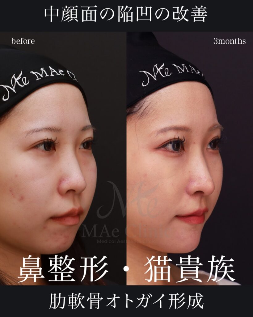 鼻中隔延長術（肋軟骨） 鼻尖形成術 鼻尖軟骨移植術 猫貴族手術（肋軟骨） 顎肋軟骨移植術（顎先軟骨移植） 症例