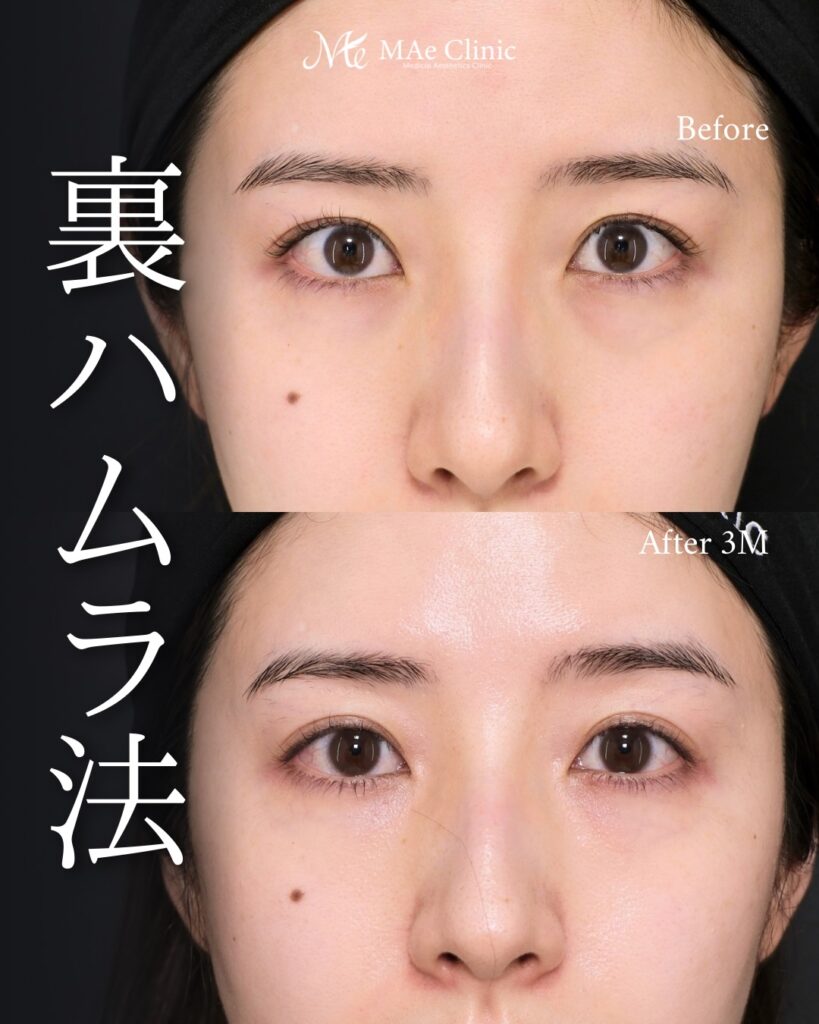 裏ハムラ法
前之園健太医師症例
