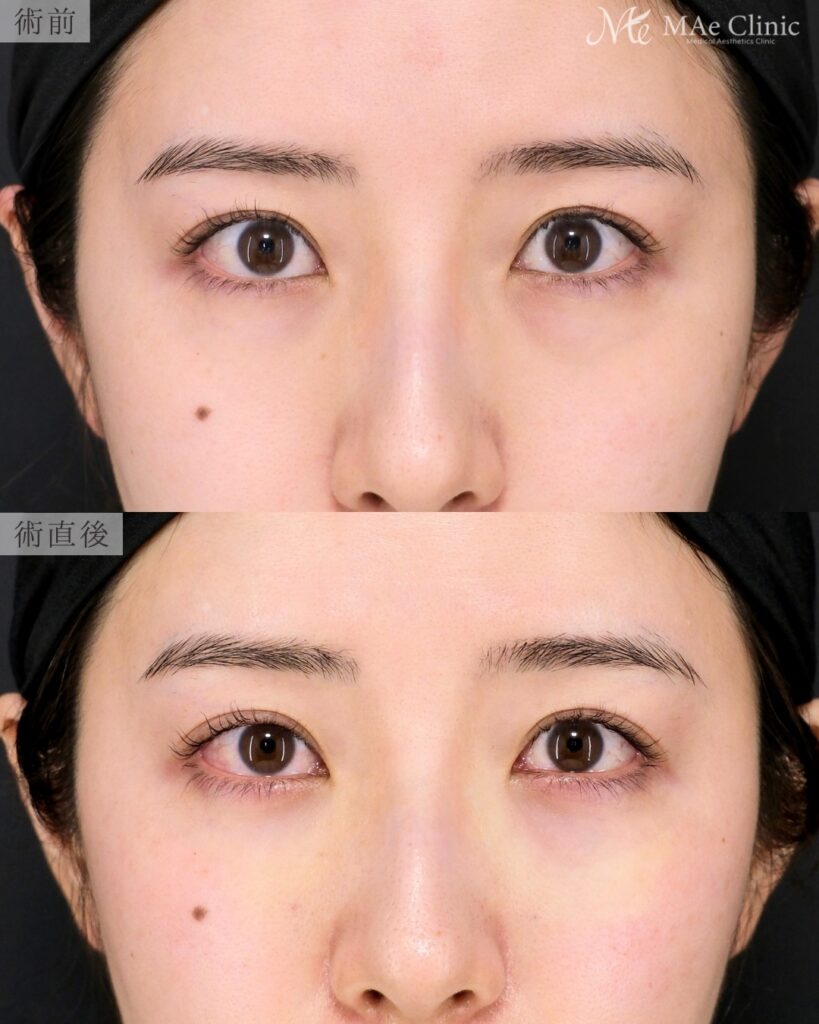 裏ハムラ法 前之園健太医師症例