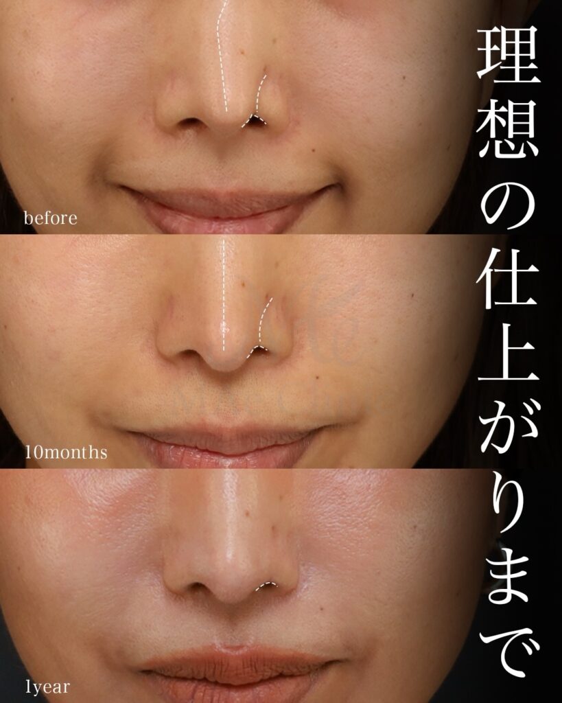 1回目：鼻フル（鼻中隔延長術＋鼻尖形成術＋鼻尖軟骨移植術）
2回目：鼻孔縁下降術
前田翔医師症例