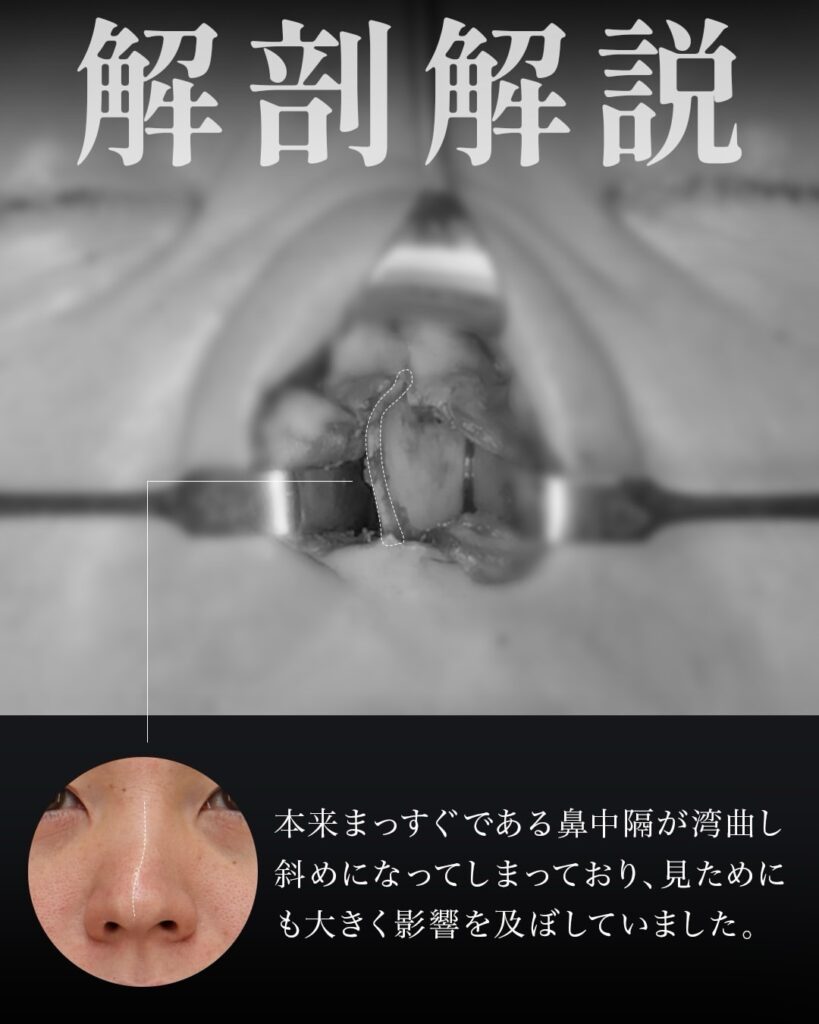 鼻フル（鼻中隔延長術＋鼻尖形成術＋鼻尖軟骨移植術） 猫貴族手術（鼻翼基部・鼻柱基部形成術） 前田翔医師症例