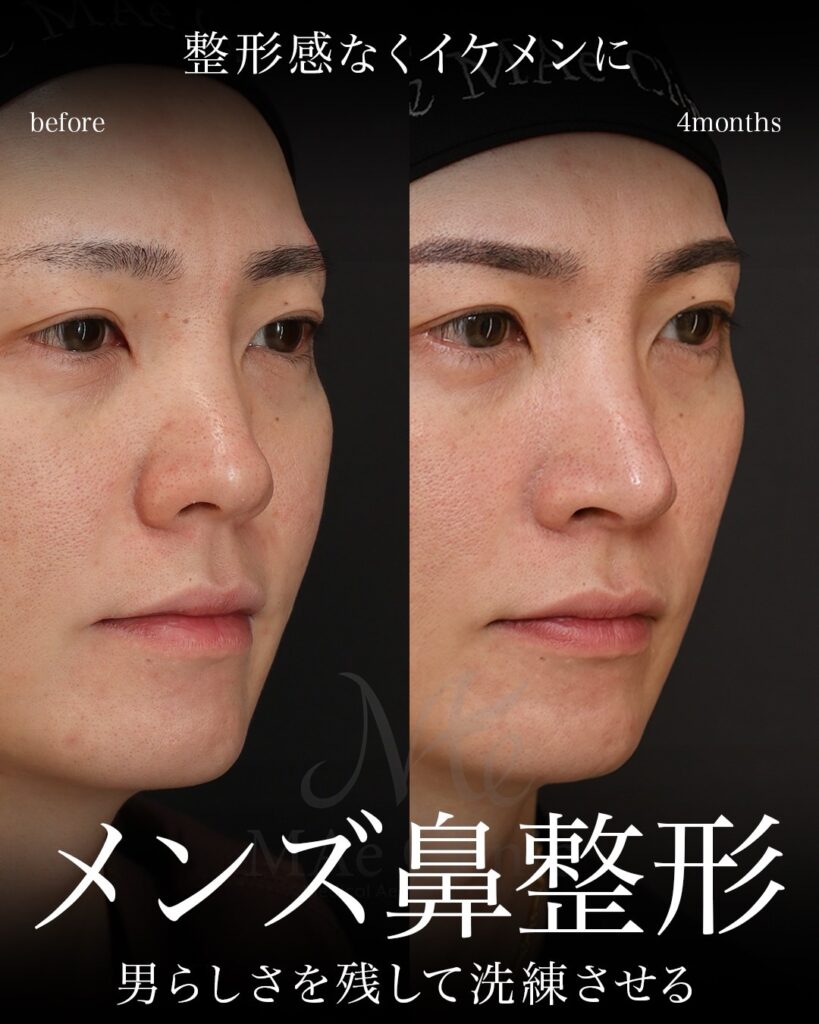 鼻フル（鼻中隔延長術＋鼻尖形成術＋鼻尖軟骨移植術） 猫貴族手術（鼻翼基部・鼻柱基部形成術） 前田翔医師症例