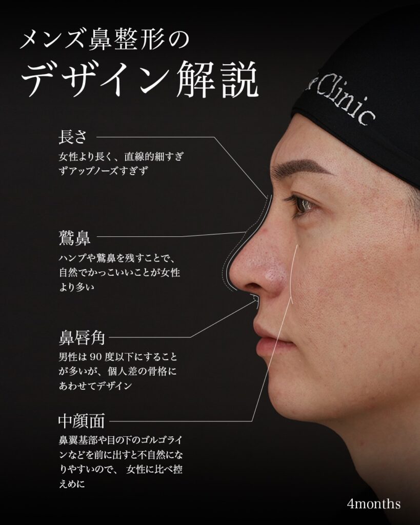 鼻フル(鼻中隔延長術+鼻尖形成術+鼻尖軟骨移植術) 猫貴族手術(鼻翼基部・鼻柱基部形成術) 前田翔医師症例