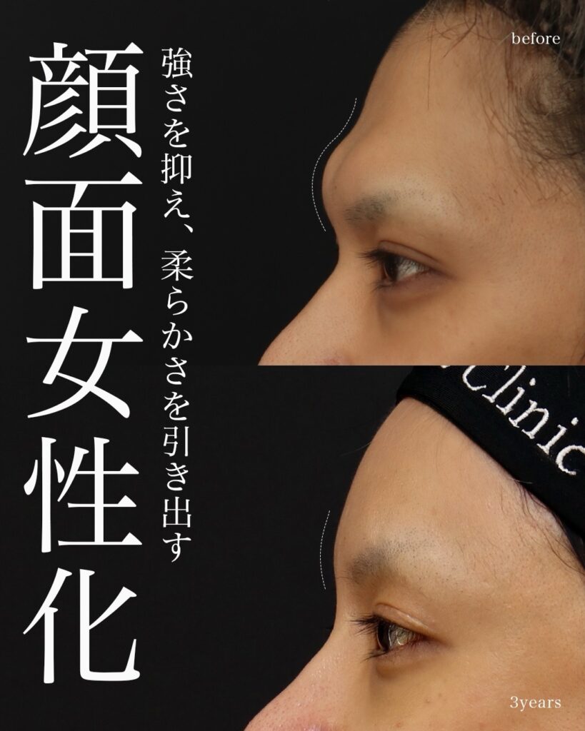前額形成 前頭洞セットバック 前額リフト 骨切り 術後3年 前田翔医師症例