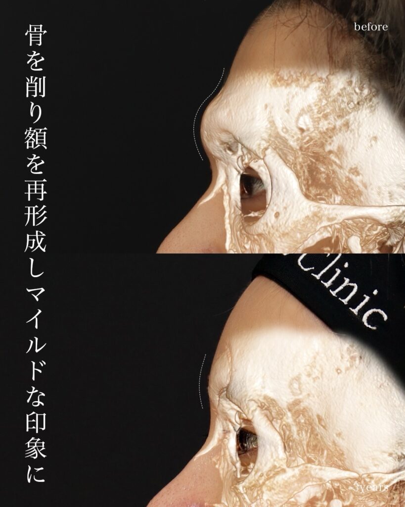 前額形成 前頭洞セットバック 前額リフト 骨切り 術後3年 前田翔医師症例