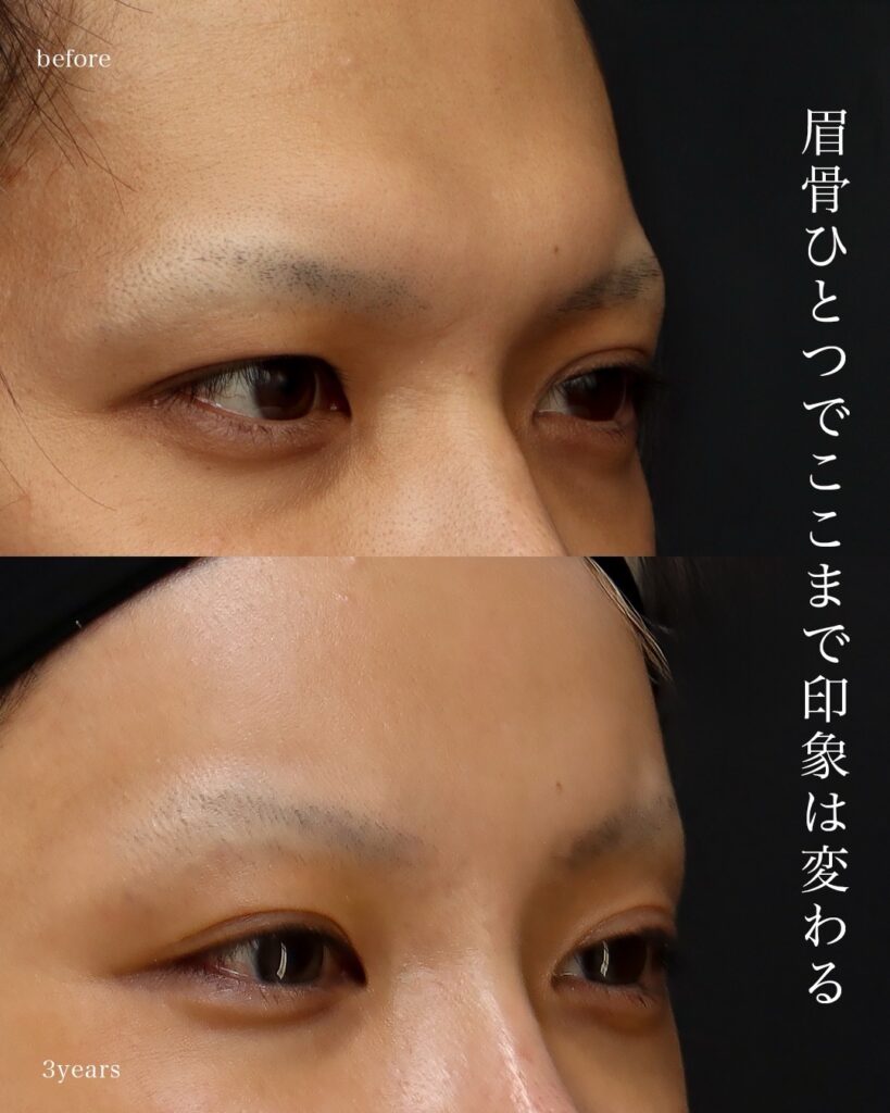 前額形成 前頭洞セットバック 前額リフト 骨切り 術後3年 前田翔医師症例