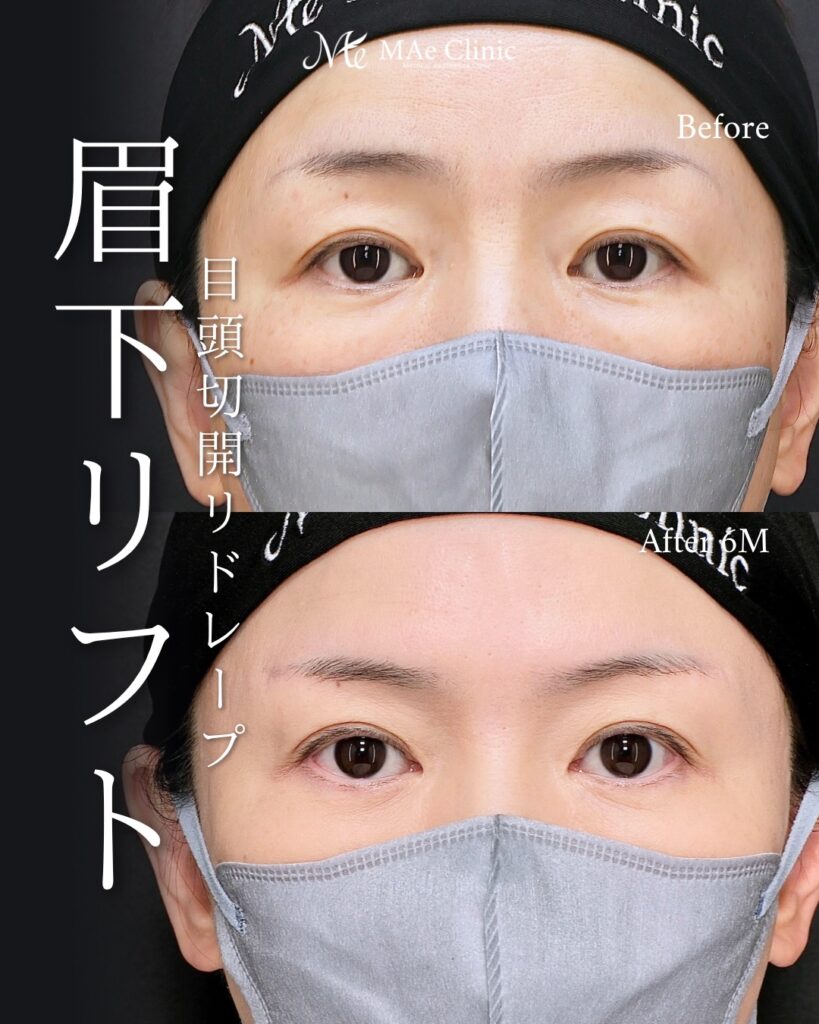 眉下リフト 目頭切開 リドレープ法 蒙古ひだ まぶたのたるみ 前之園健太医師症例