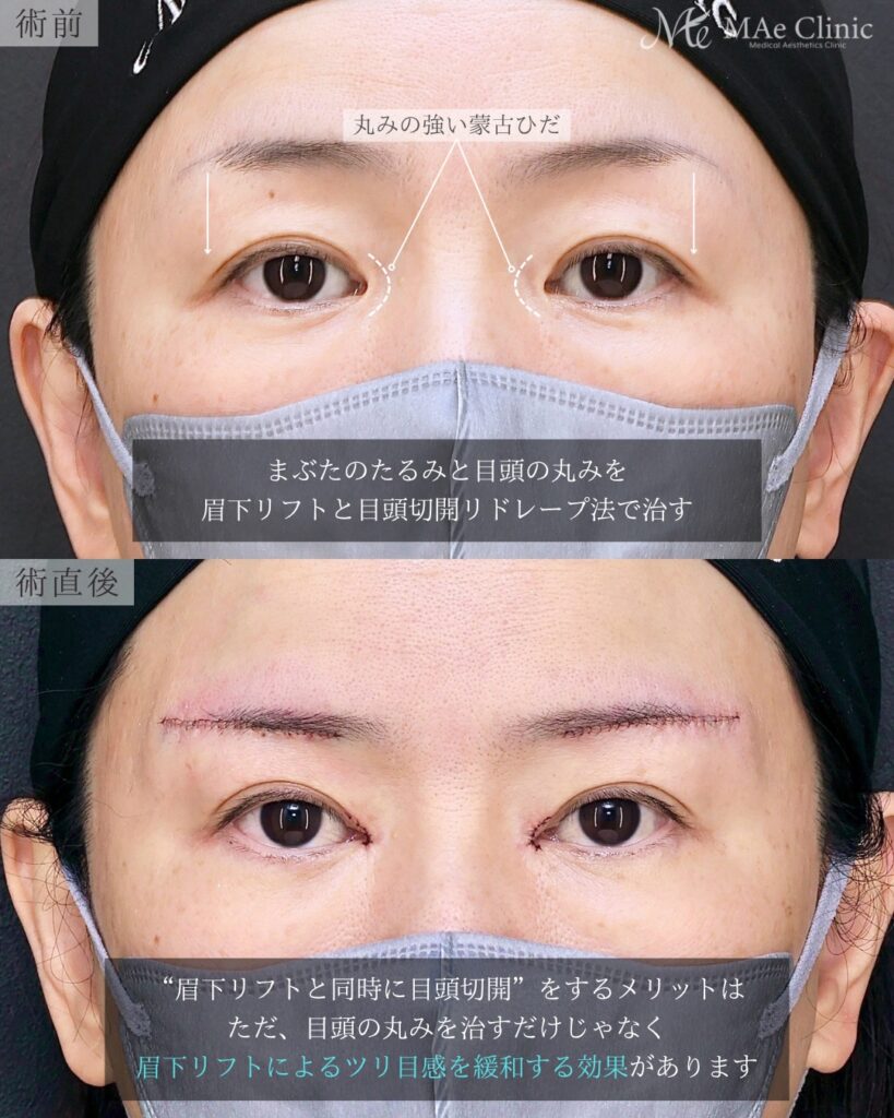 眉下リフト 目頭切開 リドレープ法 蒙古ひだ まぶたのたるみ 前之園健太医師症例