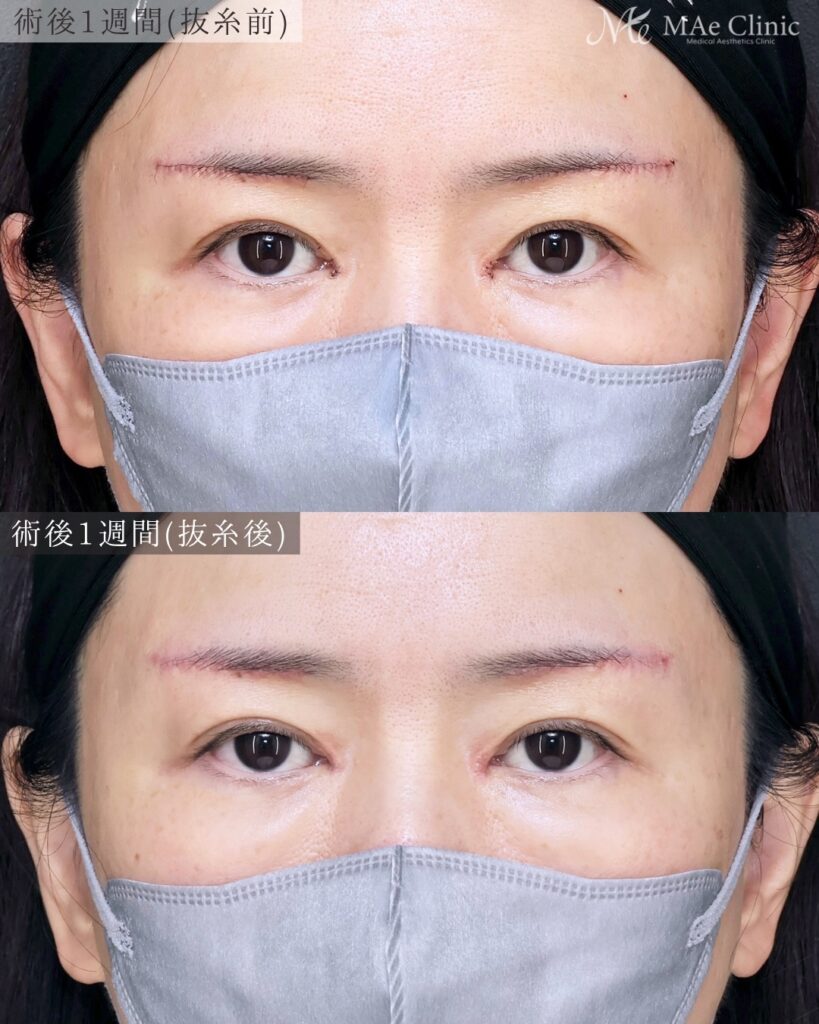 眉下リフト 目頭切開 リドレープ法 蒙古ひだ まぶたのたるみ 前之園健太医師症例