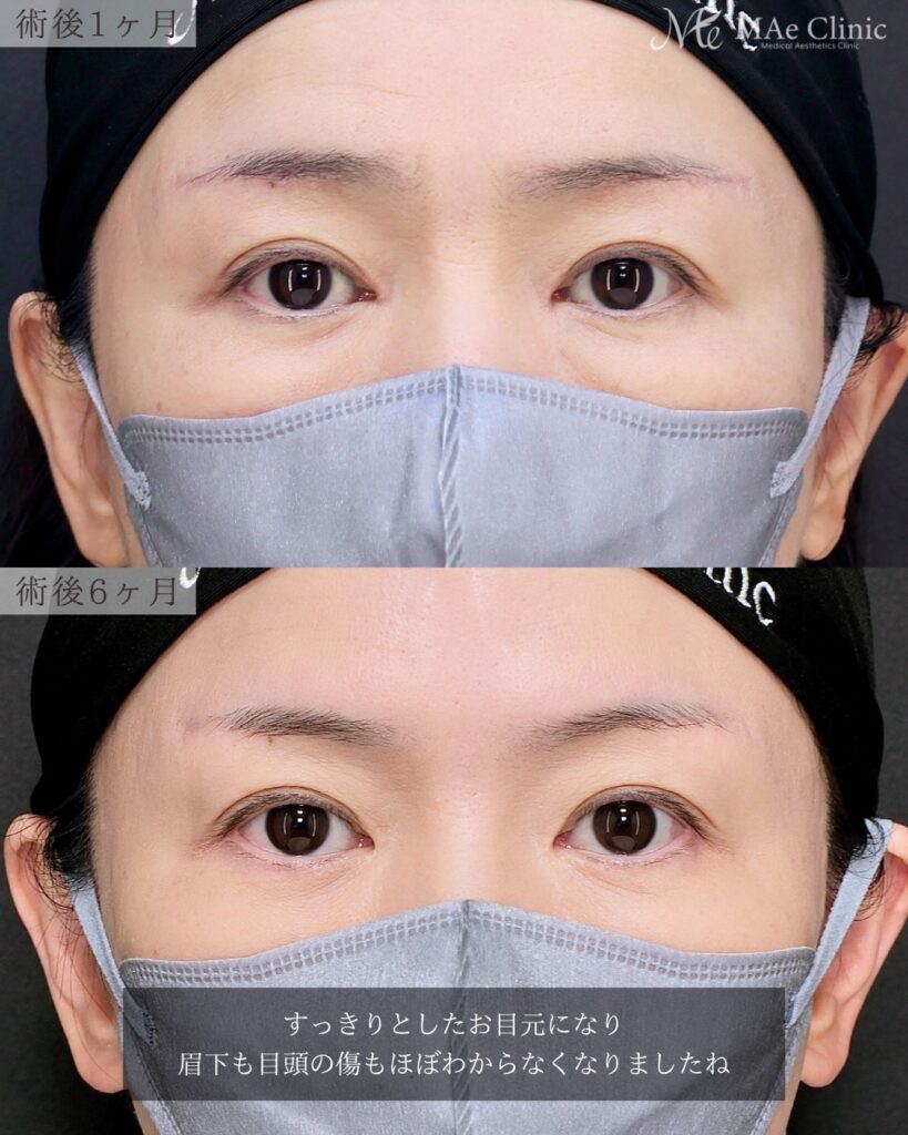 眉下リフト 目頭切開 リドレープ法 蒙古ひだ まぶたのたるみ 前之園健太医師症例