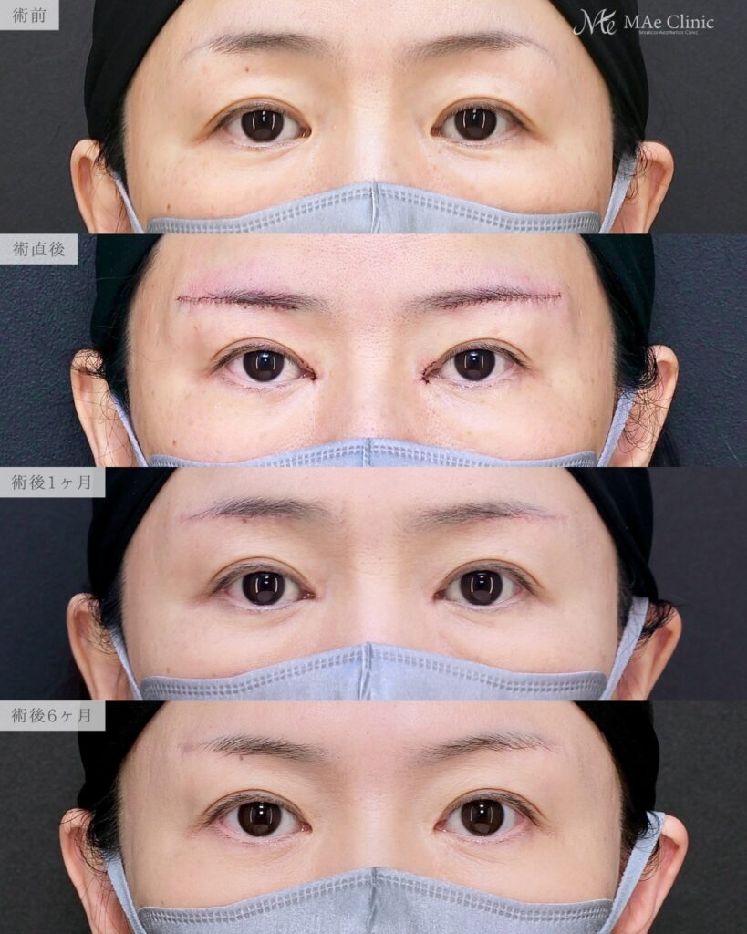 眉下リフト 目頭切開 リドレープ法 蒙古ひだ まぶたのたるみ 前之園健太医師症例
