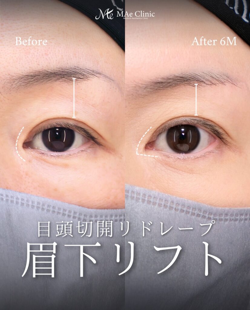 眉下リフト つり目改善 目頭切開 リドレープ法 蒙古ひだ まぶたのたるみ 前之園健太医師症例