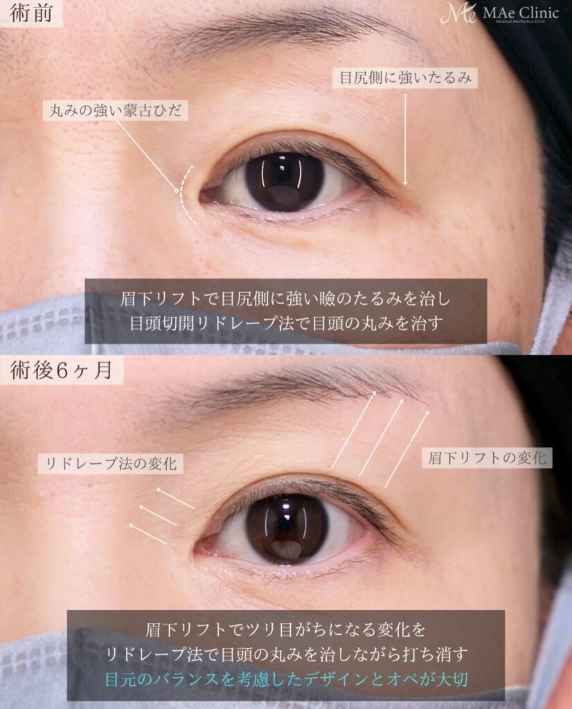 眉下リフト つり目改善 目頭切開 リドレープ法 蒙古ひだ まぶたのたるみ 前之園健太医師症例