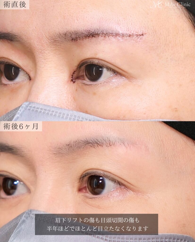 眉下リフト つり目改善 目頭切開 リドレープ法 蒙古ひだ まぶたのたるみ 前之園健太医師症例