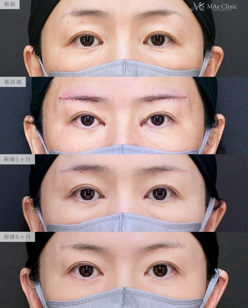 眉下リフト つり目改善 目頭切開 リドレープ法 蒙古ひだ まぶたのたるみ 前之園健太医師症例