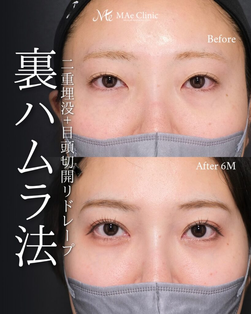 二重埋没 目頭切開 リドレープ法 裏ハムラ法 クマ取り 術後6ヶ月 前之園健太医師症例