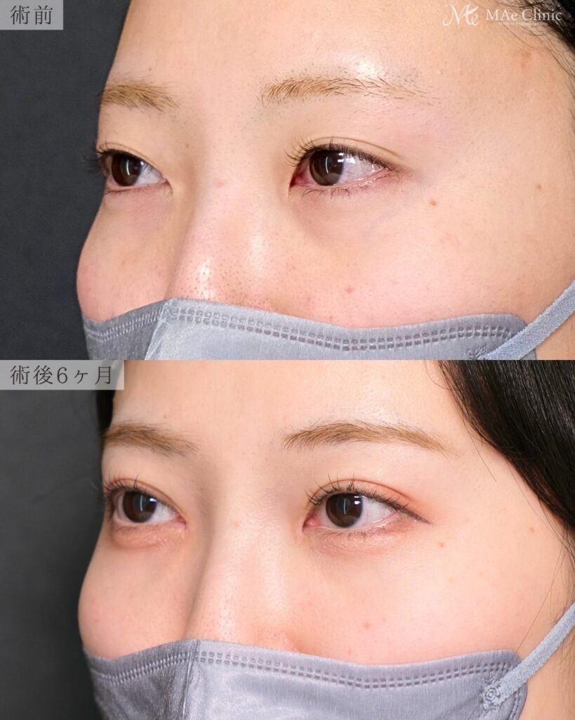 二重埋没 目頭切開 リドレープ法 裏ハムラ法 クマ取り 術後6ヶ月 前之園健太医師症例