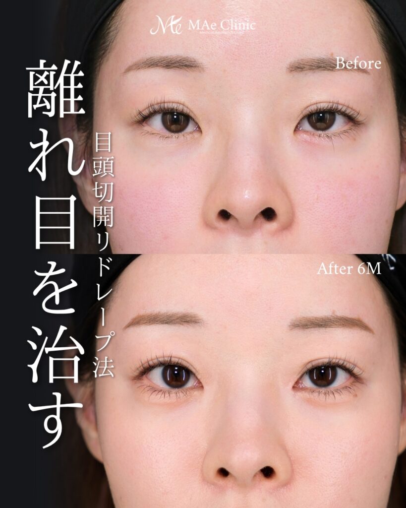 目頭切開 リドレープ法 離れ目改善 蒙古ひだ 前之園健太医師症例