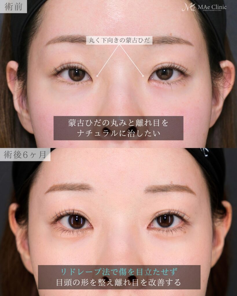 目頭切開 リドレープ法 離れ目改善 蒙古ひだ 前之園健太医師症例