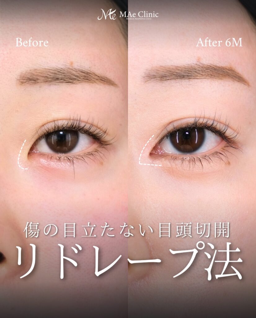 目頭切開 リドレープ法 傷跡が目立たない 蒙古ひだ 前之園健太医師症例