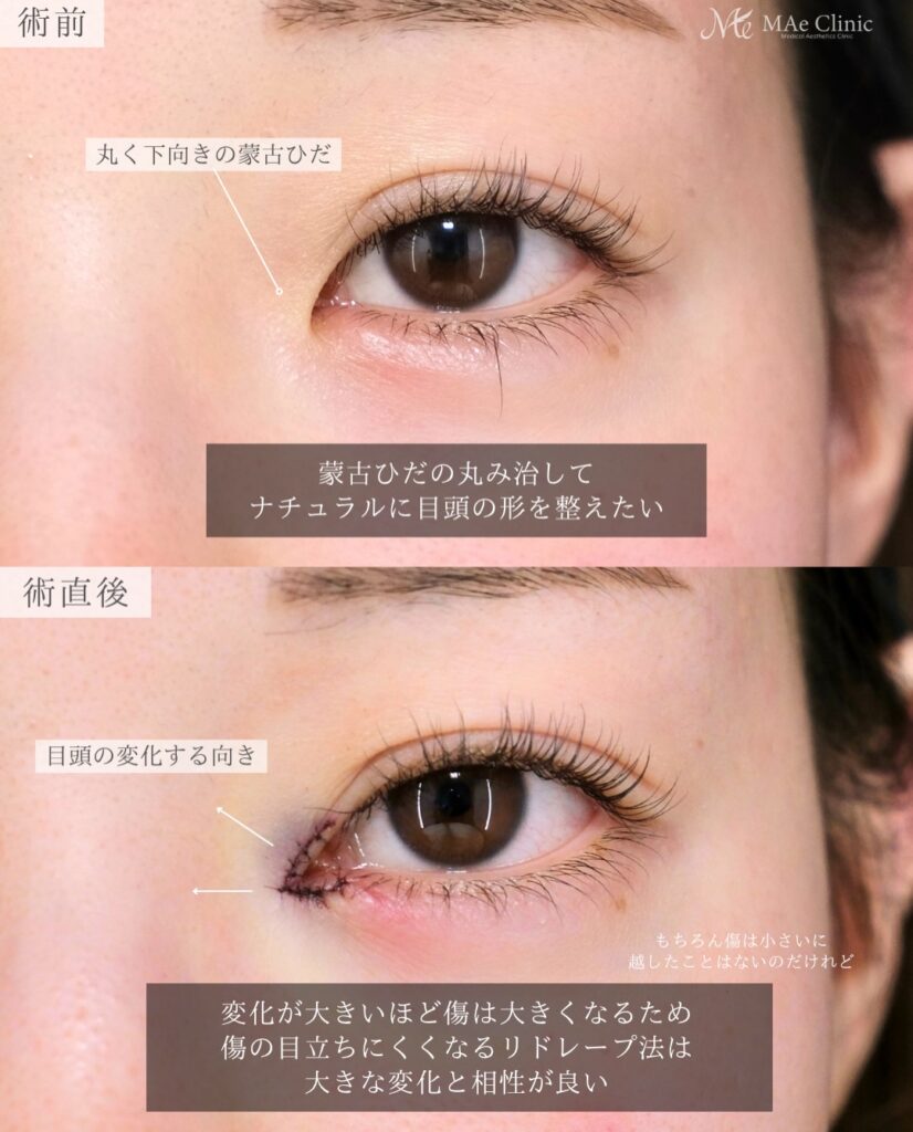 目頭切開 リドレープ法 傷跡が目立たない 蒙古ひだ 前之園健太医師症例