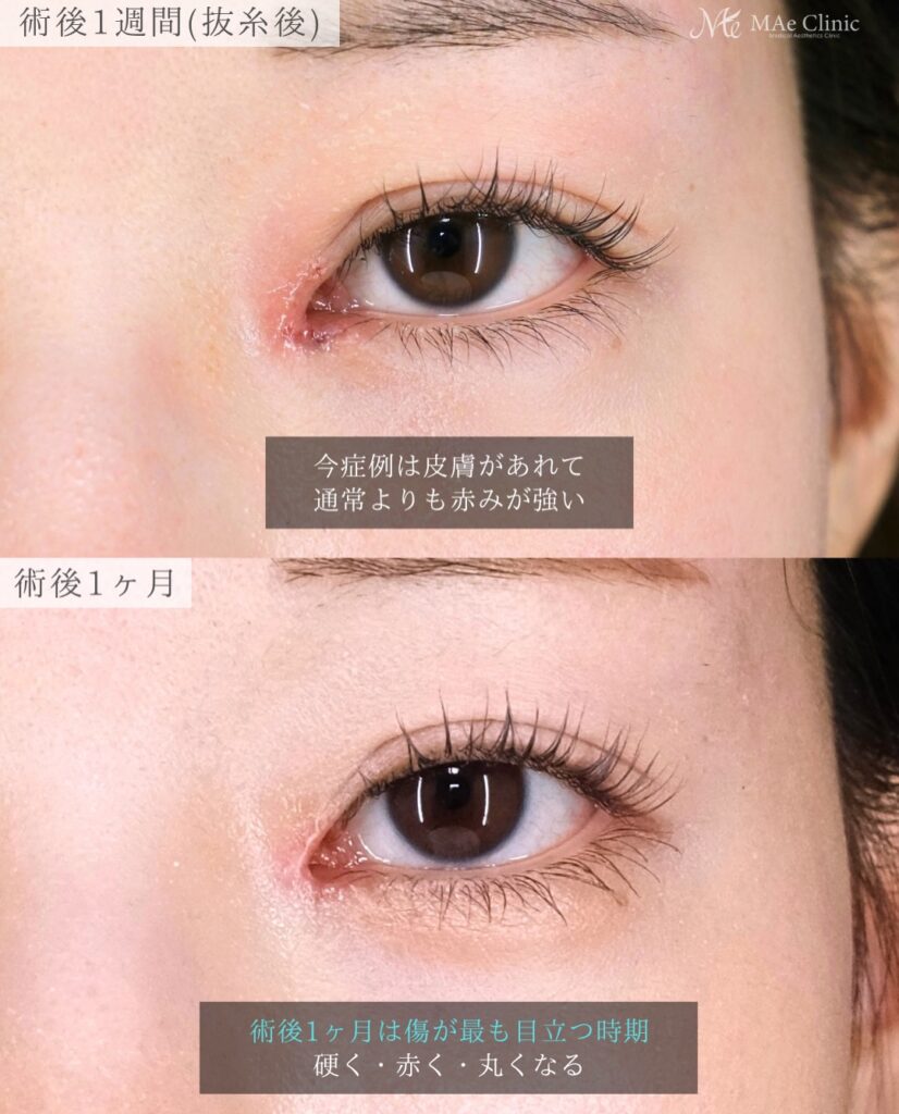 目頭切開 リドレープ法 傷跡が目立たない 蒙古ひだ 前之園健太医師症例