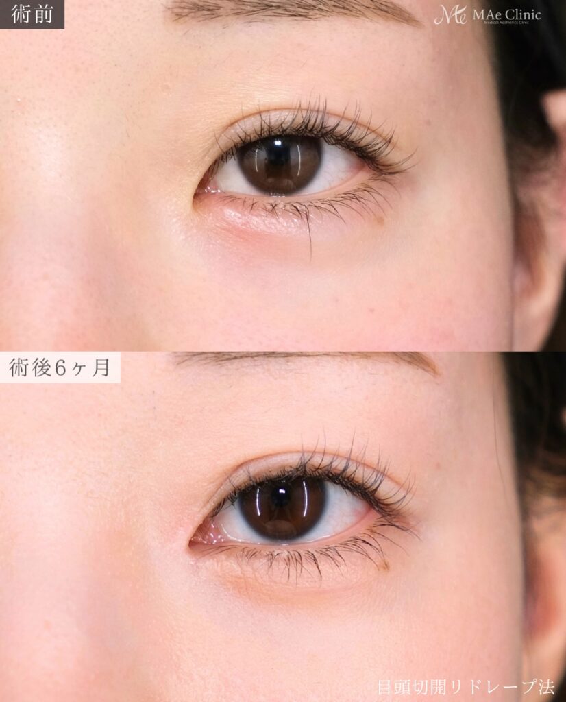 目頭切開 リドレープ法 傷跡が目立たない 蒙古ひだ 前之園健太医師症例