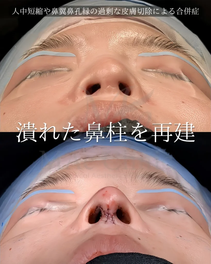 人中短縮修正 鼻柱再建 5flap 局所皮弁 肋軟骨 鼻中隔延長 前田翔医師症例
