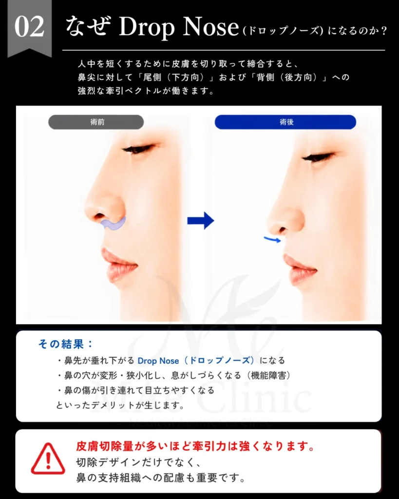 人中短縮修正 鼻柱再建 5flap 局所皮弁 肋軟骨 鼻中隔延長 前田翔医師症例