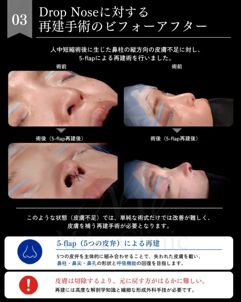 人中短縮修正 鼻柱再建 5flap 局所皮弁 肋軟骨 鼻中隔延長 前田翔医師症例