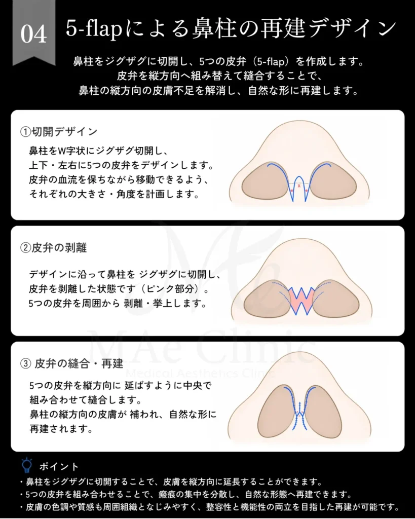 人中短縮修正 鼻柱再建 5flap 局所皮弁 肋軟骨 鼻中隔延長 前田翔医師症例