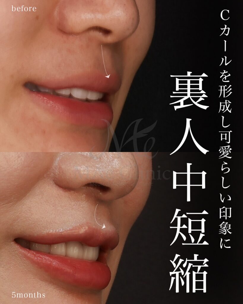 裏側人中短縮 人中厚み調整3D Cカール 中顔面短縮 術後5ヶ月 前田翔医師症例