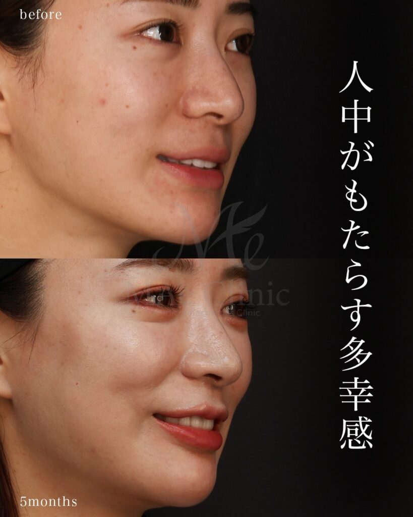 裏側人中短縮 人中厚み調整3D Cカール 中顔面短縮 術後5ヶ月 前田翔医師症例