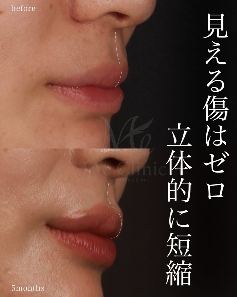 裏側人中短縮 人中厚み調整3D Cカール 中顔面短縮 術後5ヶ月 前田翔医師症例